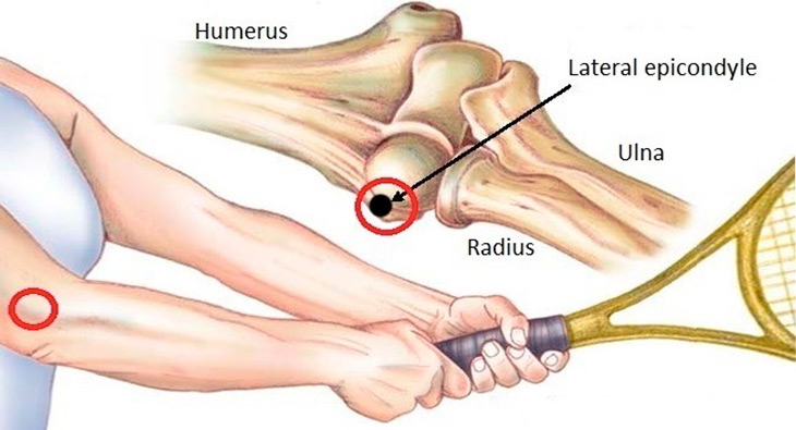 Epicondilite Lateral do Cotovelo