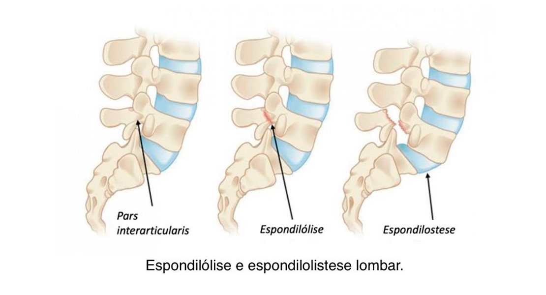 Osteoporose