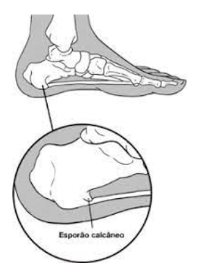 esporão do osso calcâneo