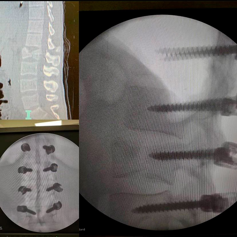 Paciente jovem com fratura traumática na transição toracolombar, submetido a instrumentação percutânea (mínima abertura de pele e sem dissecção de planos musculares. Cirurgia mais rápida, menos invasiva e menos dolorosa do que a técnica aberta tradicional) para estabilização da fratura e prevenção de deformidade ou déficit neurológico