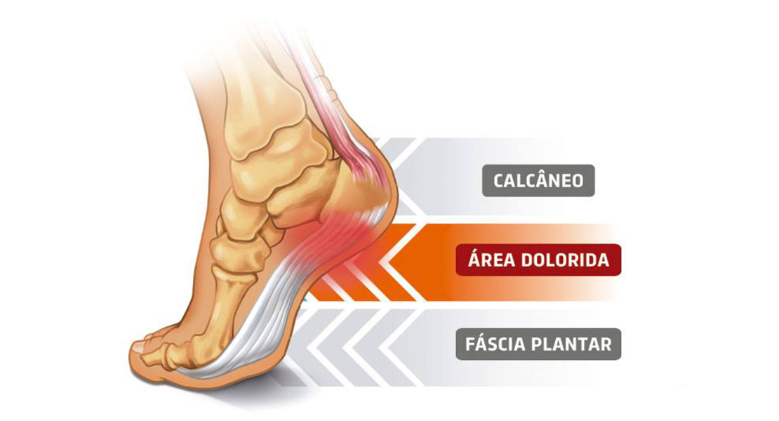 O que é Fascite Plantar?