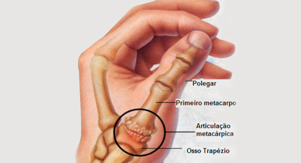 O QUE É RIZARTROSE?