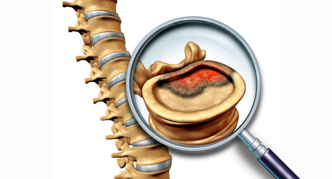 Tumores da Coluna Vertebral